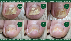 Produits coréens Dr.Kralle PEDI SAVER champignon du pied, champignon de l'ongle d'orteil, eruption de la teigne, traitement de la teigne, infection fongique - Product Image 6