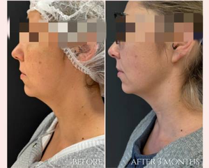 Máquina portátil de endoláser láser de fibra óptica de 1470nm para resultados efectivos de liposucción de lipólisis de Estiramiento facial-Plástico de calidad - Product Image 5