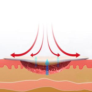 Alexer NPWT kustom untuk pembuangan kaki diabetes rias luka silikon tahan air rias busa penyerap Super - Product Image 6
