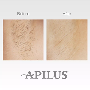 Nouvelles ventes Épilateur Apilus Senior 3G - Product Image 3