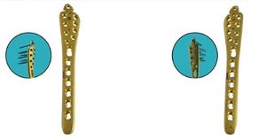 <b>Titanium</b> Locking Distal Lateral <b>Plate</b> 2.7/3.5mm x 9 Holes Right PACK OF Ce Approved - Product Image 2