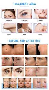 Equipo de Estética Staripl, Máquina de Radiofrecuencia Fraccionada para el Tratamiento del Acné, Tensado de la Piel, Lifting Facial, Eliminación de Arrugas - Product Image 2