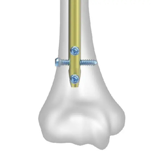 Clou intramédullaire huméral en acier inoxydable, instrument chirurgical orthopédique manuel de haute qualité, certifié CE, réutilisable - Product Image 3