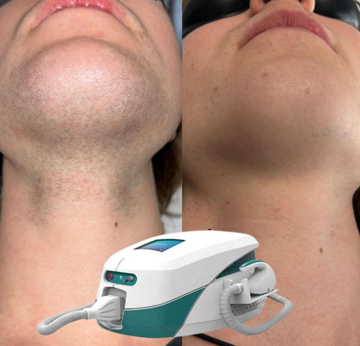 SHR-SSR-Super-Hair-Removal-