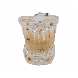 Modèle de pathologie dentaire avec demi-implant, modèle anatomique des dents pour l'enseignement dentaire, l'étude et la communication patient-dentiste - Product Image 3