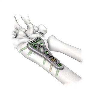 Produsen ortopedi Titanium dokter hewan <span class=keywords><strong>Femur</strong></span> Distal L piring pengunci untuk perbaikan lengan pada anjing dan kucing - Product Image 4