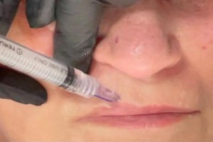 นาโนซอฟท์ 34G นาโนนีดเดิล 3 หัวเข็ม ขนาด 0.6 มม. 0.8 มม. 1.0 มม. 1.2 มม. 1.5 มม. สำหรับฟื้นฟูผิว นาโนซอฟท์ อากูจาส - Product Image 5