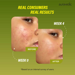Acne Spots <b>Face</b> Care Set Complete Solution with Custom Logo Vegan Ingredients Salicylic Acid Collagen for Home Use OEM Supply - Product Image 5