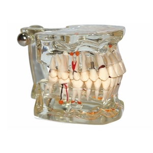 Modèle de pathologie dentaire avec demi-implant, modèle anatomique des dents pour l'enseignement dentaire, l'étude et la communication patient-dentiste - Product Image 2