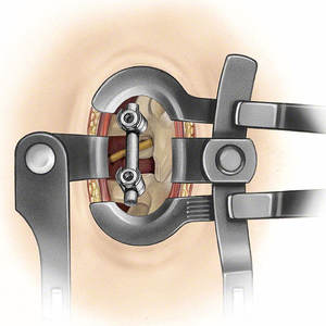Juego de Instrumentos Quirúrgicos de Columna Vertebral para Neurocirugía Manual Profesional, Acero Inoxidable de Grado Médico, Separadores, Retractores y Fijadores - Product Image 6