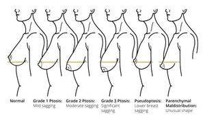 Élévateur des seins pour la plastie mammaire Élévateur des seins Instruments de chirurgie plastique Élévateur mammaire Mammostat Mahersi - Product Image 5