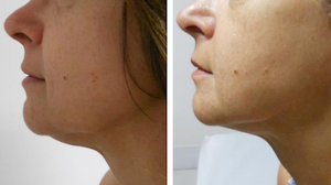 Diodo Endolaser de doble onda 980 1470 nm Diodo médico <span class=keywords><strong>Láser</strong></span> Estiramiento facial Lipólisis Máquina <span class=keywords><strong>Precio</strong></span> de fábrica para la venta - Product Image 4