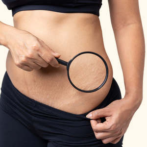 Organic Anti-Stretch Mark Extract Oil <b>Blend</b> Moisturising Body Cream and Lotion for Weight Loss - Product Image 1