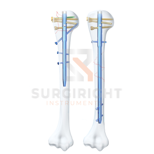 Implante Ortopédico Médico Profesional de Acero Inoxidable, Clavo Interlocking Multiloc Humeral, Manual, Certificado CE por Surgiright - Product Image 3