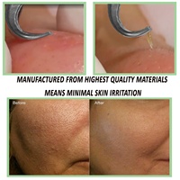 Nouveau logo OEM Extracteur de boutons en acier inoxydable Extracteur de points noirs Pince à épiler Traitement écologique de l'acné Visage Nez Beauté
