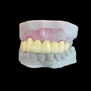 Pont <span class=keywords><strong>dentaire</strong></span> en porcelaine fusionnée au métal (PFM) fiable, couronne pour une restauration <span class=keywords><strong>dentaire</strong></span> fonctionnelle et esthétique - Product Image 1