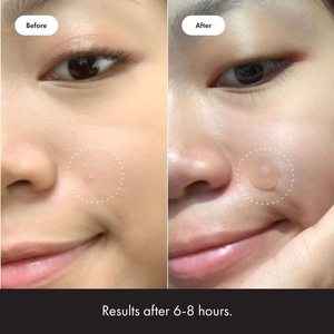 แผ่นแปะเดิมโดยเครื่องสำอางฮีโร่แผ่นรักษาสิวแบบดั้งเดิมแผ่นแปะสิว-ไฮโดรคอลลอยด์24ชิ้นมีจำหน่ายในร้าน