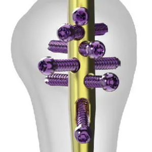 Clou intramédullaire huméral en acier inoxydable, instrument chirurgical orthopédique manuel de haute qualité, certifié CE, réutilisable - Product Image 5