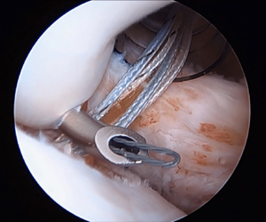 อุปกรณ์ผ่าตัดกระดูกและข้อ  ชุดเย็บแผลแบบล็อค  สำหรับการผ่าตัดส่องกล้องข้อไหล่  อุปกรณ์การแพทย์ - Product Image 6