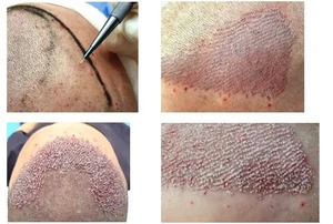 Zafiro oftálmico Hoja de un solo borde Hoja quirúrgica Ojo reutilizable Cuchillo de un solo borde Herramientas Instrumentos Surtechs - Product Image 5