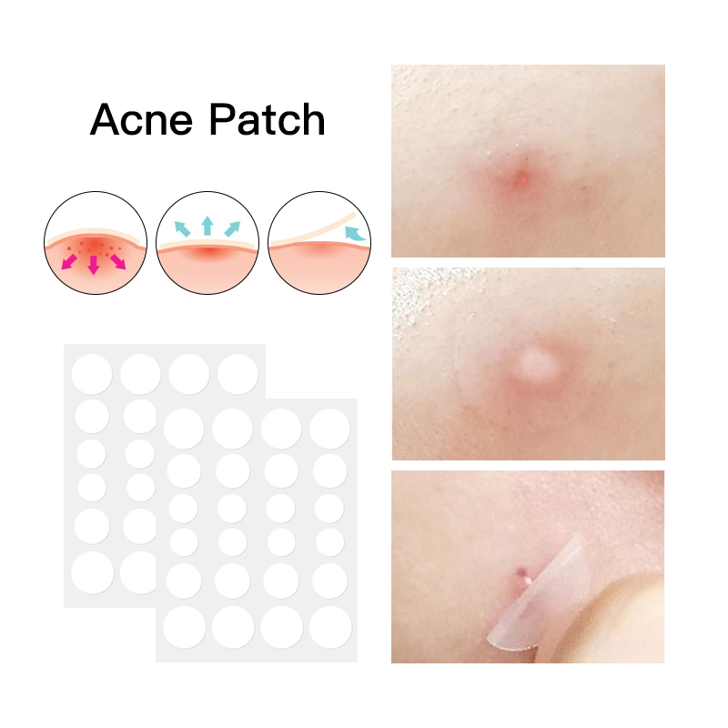 Huile d'arbre à thé points hydrocolloïdes traitement de l'acné Patch de guérison des boutons patchs d'acné de marque privée