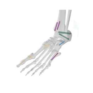 Juego de Instrumentos Quirúrgicos Ortopédicos de Acero Inoxidable de Alta Calidad, Reutilizables, para Bloqueo de Tibia y Fémur, con Cánula y sin Cabeza - Product Image 5