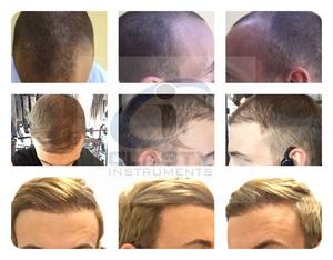 PINZAS PARA TRASPLANTE DE CABELLO DE ACERO INOXIDABLE 12CM PARA INSTRUMENTOS PARA TRASPLANTE DE CABELLO JUEGO DE INSTRUMENTOS QUIRÚRGICOS - Product Image 4