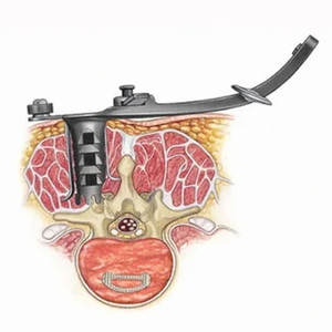 Juego de Instrumentos Quirúrgicos de Columna Vertebral para Neurocirugía Manual Profesional, Acero Inoxidable de Grado Médico, Separadores, Retractores y Fijadores - Product Image 3