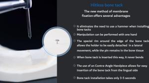 Bone tack dentaire en gros pour tous les types d'os - Product Image 2