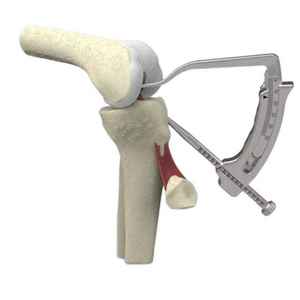 Juego de Instrumentos Ortopédicos para Reconstrucción de Ligamento Cruzado, Manual, Alta Calidad, Certificado CE por Surgi Right - Product Image 5