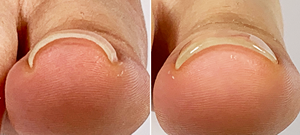Gel funcional coreano para uñas encarnadas, corrector de uñas encarnadas para convertir las uñas encarnadas en planas o curvas, libre de TPO - Product Image 5