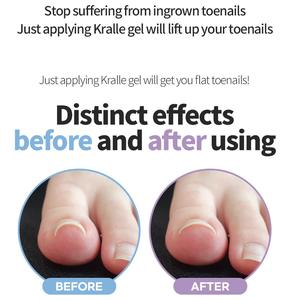 Patchs correcteurs d'ongles incarnés Dr.kralle Kralle Gel coussin correcteur d'ongles incarnés - Product Image 3