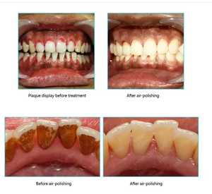 Appareil de détartrage dentaire, équipement de polissage à air pour dentiste, système de thérapie parodontale à écran tactile LCD, détartreur ultrasonique VRN Machinery - Product Image 5