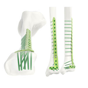 Instruments vétérinaires en gros, clous orthopédiques en titane de haute qualité, implant de tibia, clou intramédullaire expert - Product Image 1