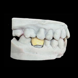 Pont <span class=keywords><strong>dentaire</strong></span> en porcelaine fusionnée au métal (PFM) fiable, couronne pour une restauration <span class=keywords><strong>dentaire</strong></span> fonctionnelle et esthétique - Product Image 3