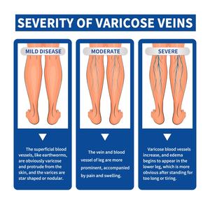 Krim Perawatan Varises South Moon Laris Manis Harga Terjangkau Kualitas Tinggi Mengatasi Bengkak Akibat Darah Keringat di Kaki, Meredakan Nyeri, Memperbaiki Pembuluh Darah, Melembapkan - Product Image 5