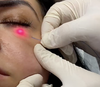 Machine laser à double longueur d'onde GIGAA VELASII 1470nm+980nm pour le traitement des poches sous les yeux, la liposuccion et l'endolifting
