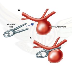 ชุดเครื่องมือสำหรับผ่าตัดหลอดเลือดแดงซิลิโคนที่หนีบสองชั้นชุดเครื่องมือสำหรับการผ่าตัดขนาดเล็กเป็นมิตรกับสิ่งแวดล้อม - Product Image 5