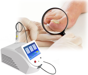 Láser de diodo de alta potencia de 980nm para <span class=keywords><strong>hongos</strong></span> <span class=keywords><strong>en</strong></span> las uñas, onicomicosis, infección por <span class=keywords><strong>hongos</strong></span> <span class=keywords><strong>en</strong></span> las uñas, máquina de <span class=keywords><strong>tratamiento</strong></span> láser de 30W y 60W a <span class=keywords><strong>la</strong></span> venta - Product Image 2