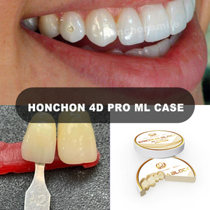 Honchon zirconio disco multistrato blocco di zirconio dentale blanks produttore cam cad blocco di <span class=keywords><strong>zirconia</strong></span> dentale prezzo - Product Image 3