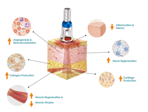 Équipement laser diode de physiothérapie portable certifié CE/MDR, haute puissance, double longueur d'onde 980+810 30W - Product Image 2