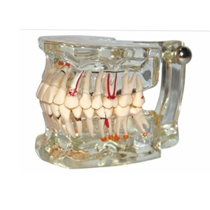 Modèle de pathologie dentaire avec demi-implant, modèle anatomique des dents pour l'enseignement dentaire, l'étude et la communication patient-dentiste - Product Image 1