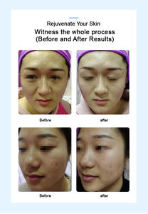 ปืนฉีดยีนแบบไม่ล่วงล้ำสำหรับกำจัดริ้วรอยเครื่องมือความงามแบบไม่ใช้เข็มไม่เจ็บ - Product Image 3