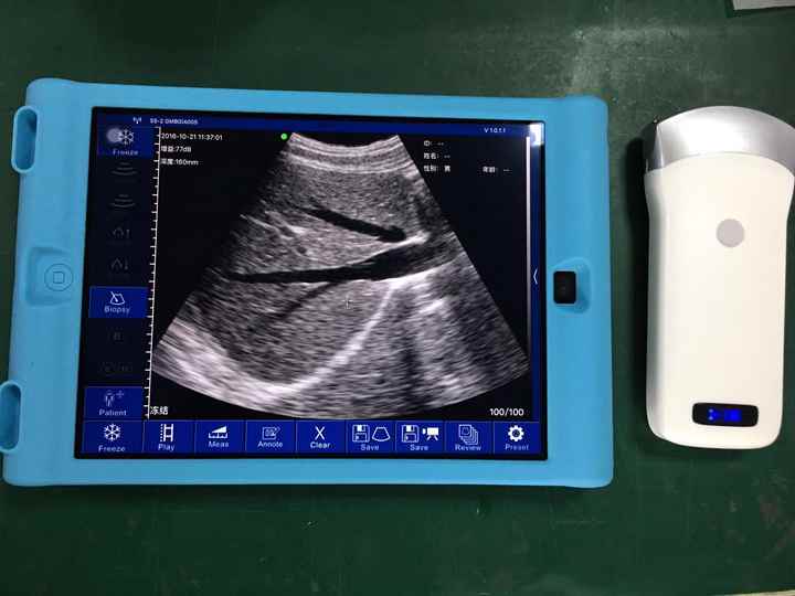 Wireless Android/ios Convex Array Usb Ultrasound Probe Ultrasound Scanner Pocket Ultrasound for Sale Price