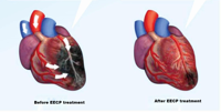 Machine EECP de FDA thaïlandaise de la CE/thérapie externe de coeur de contre-pulsation de dispositif d'ECP pour des dispositifs médicaux naturels de bypass de douleur cardiaque/angine