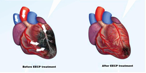جهاز CE Thai FDA EECP/جهاز علاج القلب الخارجي المضاد لآلام القلب/الذبحة الصدرية الأجهزة الطبية الطبيعية الالتفافية - Product Image 6