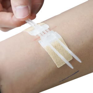 Dispositivo de Cierre de Heridas Médico, Sutura No Invasiva, Grapadora de Superficie Cutánea, Zip Stitch - Product Image 3