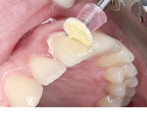 Ensemble de polissage dentaire Super Snap Buff CA, pâte de polissage composite en porcelaine, lot de 25 disques avec 1 mandrin - Product Image 3