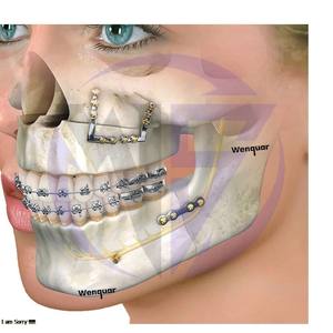Titanio quirúrgico Placa ósea en forma de T de 1,5mm | Implante de trauma facial para cirugía oral Instrumentos maxilofaciales - Product Image 2