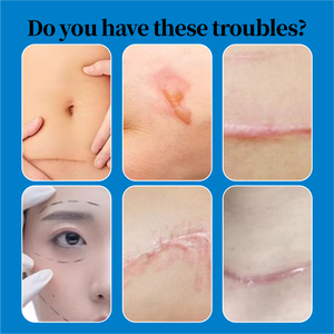 Großhandel Silikon-Narbengel für Alte und Neue Narben Fortschrittliches Medizinisches Silikon für Verbrennungen Operation Kaiserschnitt Brandnarben Narbenreparatur - Product Image 2